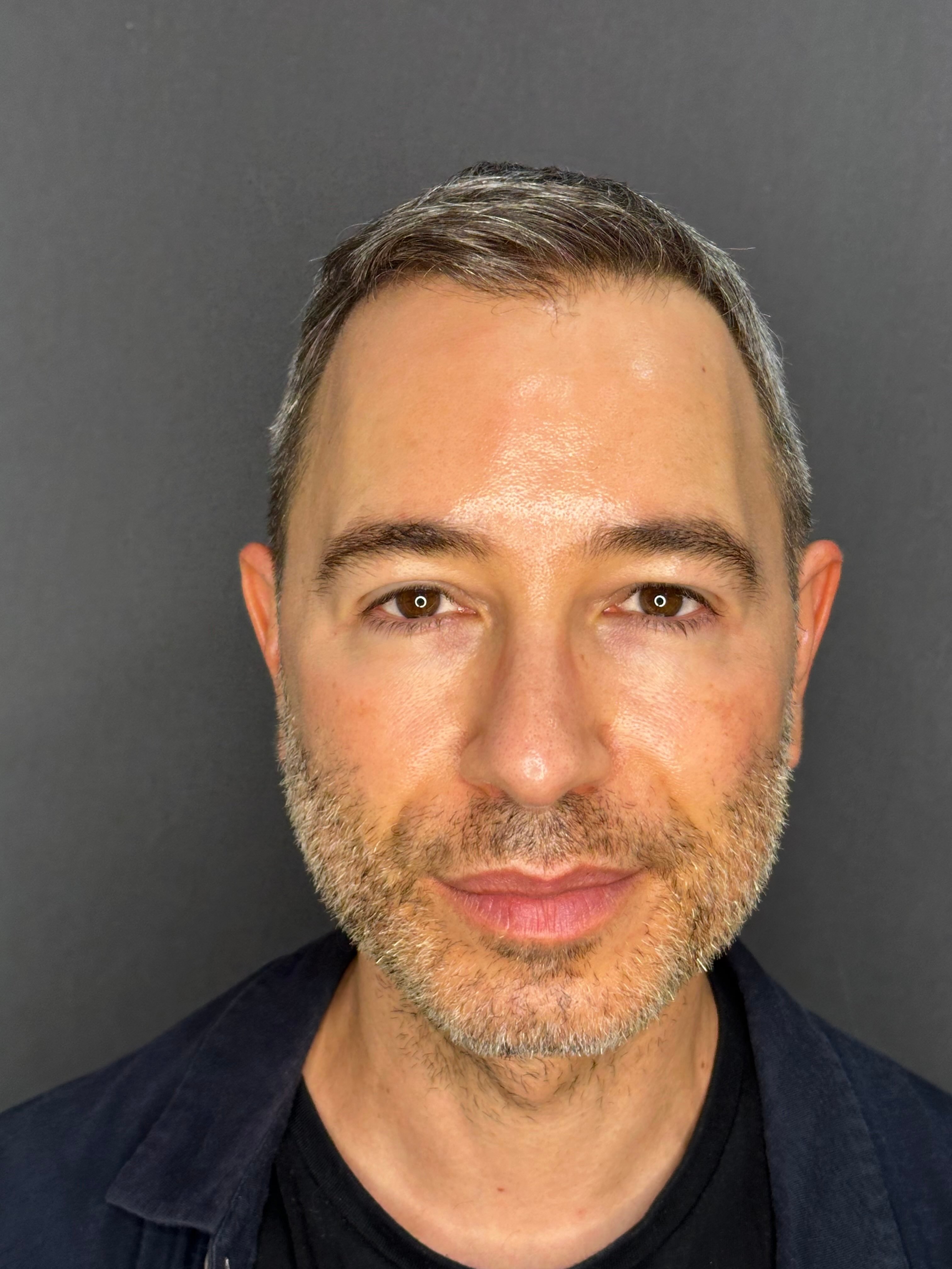 Facial Contouring after