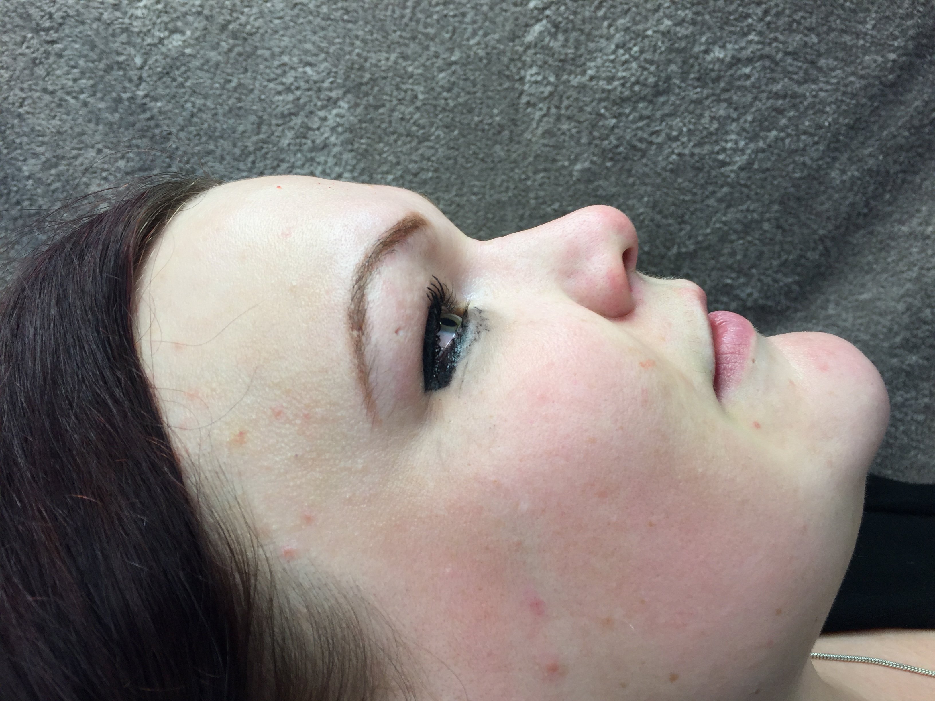 Non-Surgical Rhinoplasty after