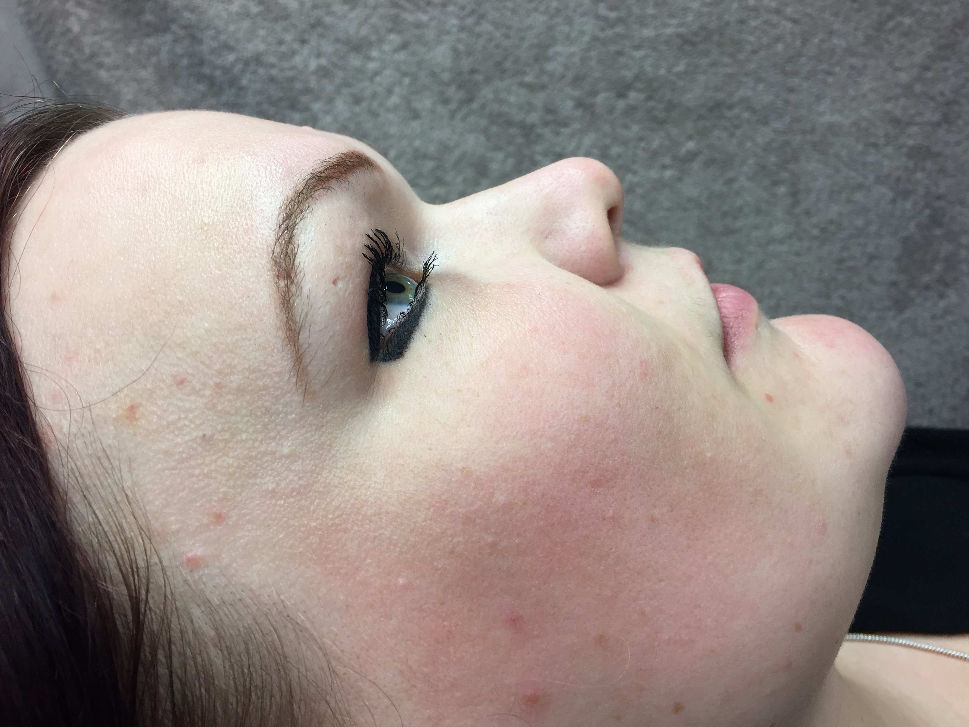 Non-Surgical Rhinoplasty before