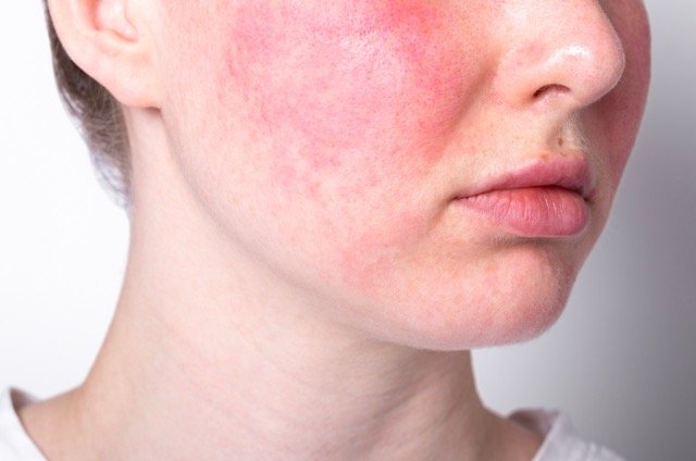 Rosacea Treatment & Management