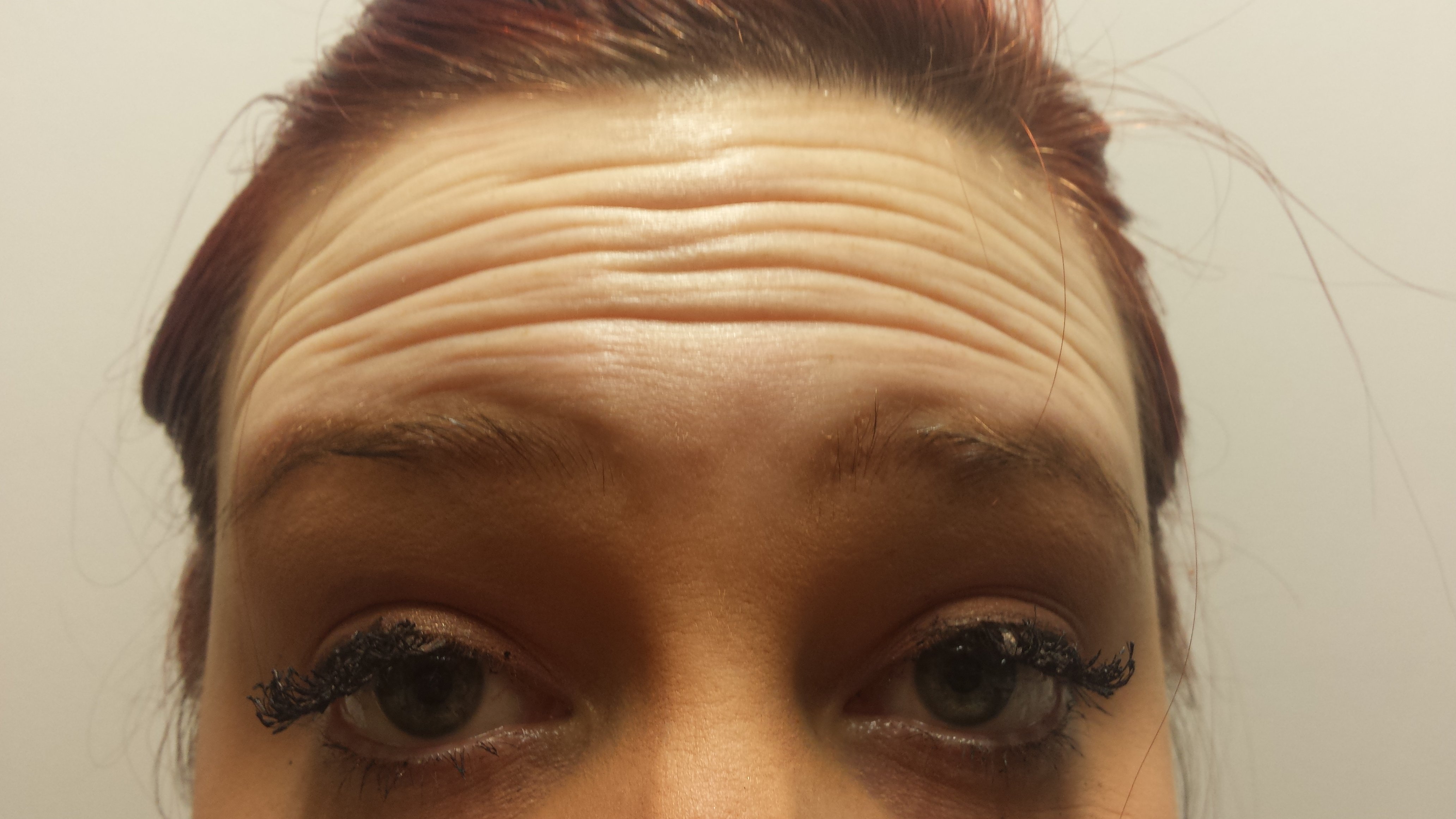 Anti-Wrinkle Injections before